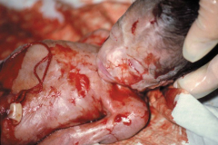 abortion-22-weeks