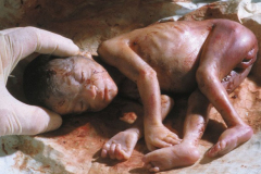 abortion-24-weeks