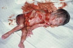 abortion-at-22-weeks
